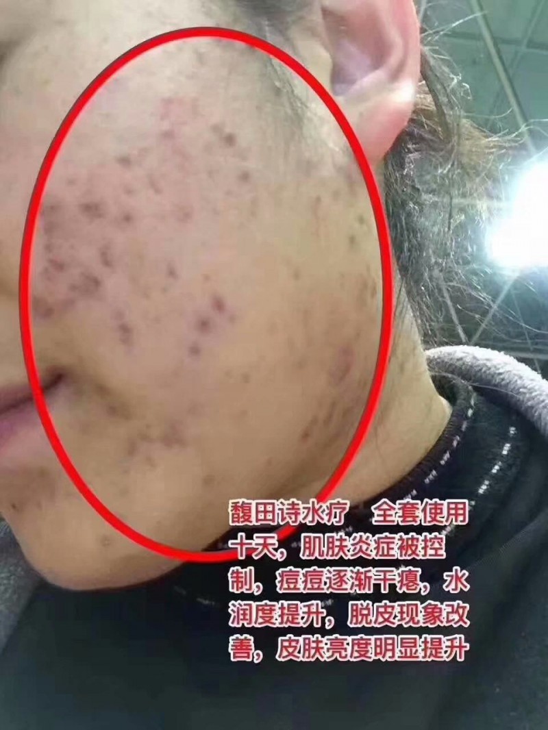 馥田诗水疗，全套使用十天，肌肤炎症被控制，痘痘逐渐干瘪，水润度提升，脱皮现象改善，皮肤亮度明显提升。